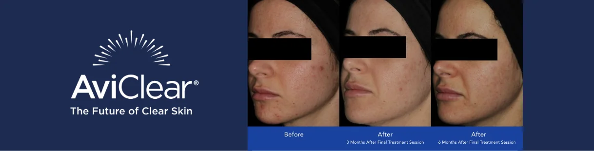 Avi Clear acne treatment before and after of a woman with severe acne
